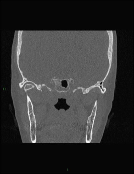 Bilateral frontal mucoceles (Radiopaedia 82352-96454 Coronal 262).jpg