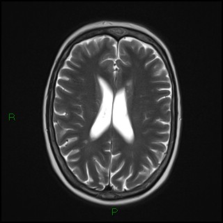 File:Bilateral frontal mucoceles (Radiopaedia 82352-96455 Axial T2 13).jpg