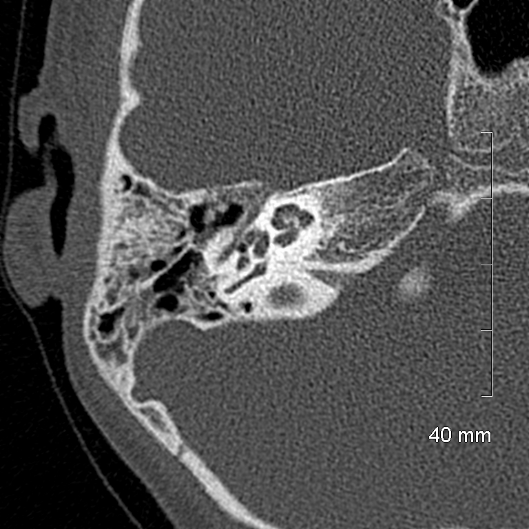 Bilateral grommets (Radiopaedia 47710-52404 Axial bone window 39).jpg