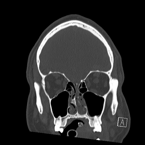 Bilateral occipital condyle fracture (type 2) (Radiopaedia 87675-104089 Coronal bone window 16).jpg