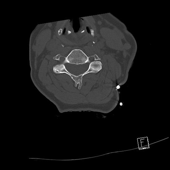 Bilateral occipital condyle fractures (type 3) (Radiopaedia 87672-104086 Axial bone window 42).jpg