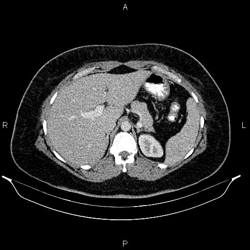 Bilateral ovarian dermoid cysts (Radiopaedia 85785-101603 A 30).jpg
