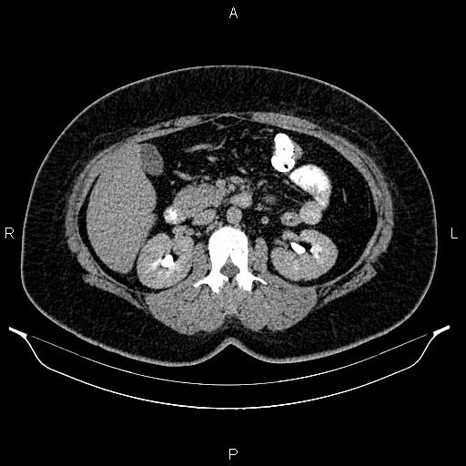 Bilateral ovarian dermoid cysts (Radiopaedia 85785-101603 Axial C+ delayed 27).jpg