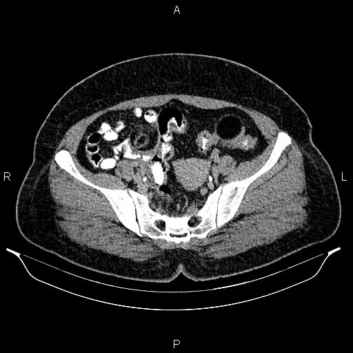 Bilateral ovarian dermoid cysts (Radiopaedia 85785-101603 Axial C+ delayed 64).jpg
