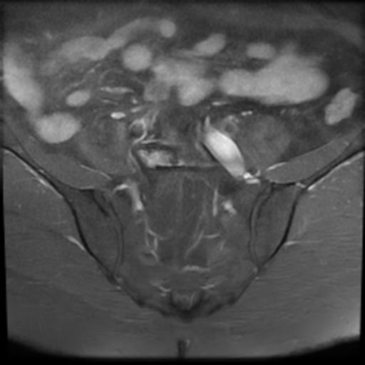 File:Bilateral ovarian dermoid cysts (Radiopaedia 90152-107338 Axial T1 C+ fat sat 4).jpg