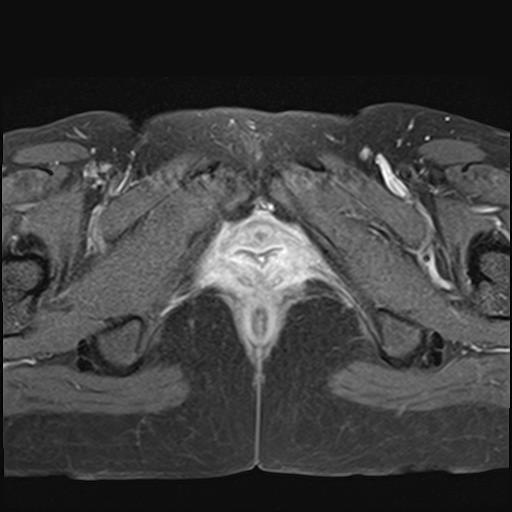 File:Bilateral ovarian endometriomas (Radiopaedia 87085-103347 Axial T1 C+ fat sat 22).jpg