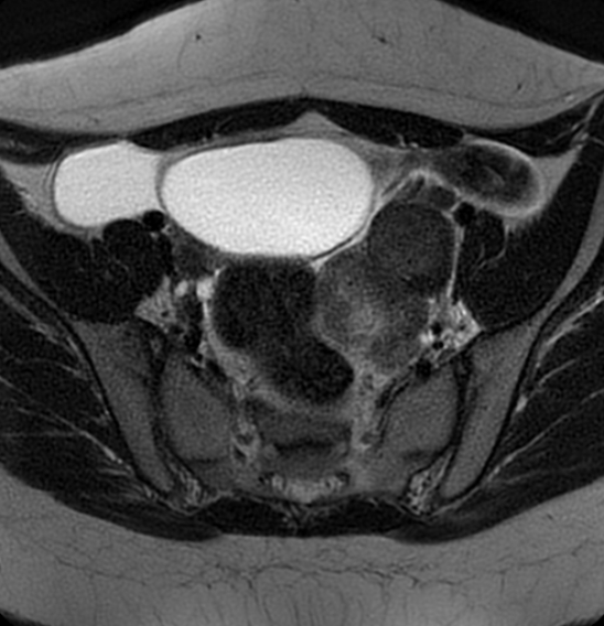 File:Bilateral ovarian fibrothecomas - adolescent (Radiopaedia 86604-102707 Axial T2 16).jpg