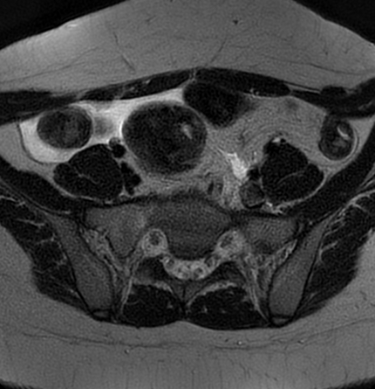 File:Bilateral ovarian fibrothecomas - adolescent (Radiopaedia 86604-102707 Axial T2 9).jpg