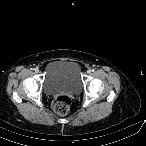 Bilateral ovarian serous cystadenocarcinoma (Radiopaedia 86062-101989 B 97).jpg