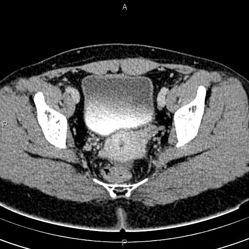 File:Bilateral ovarian teratoma (Radiopaedia 83131-97503 B 53).jpg