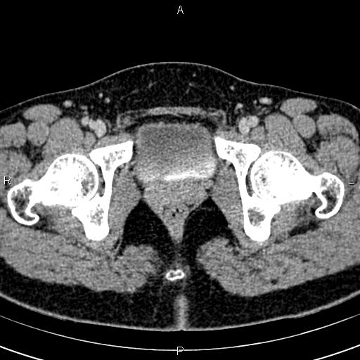 Bilateral ovarian teratoma (Radiopaedia 83131-97503 B 73).jpg