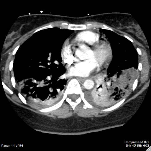 Bilateral pulmonary emboli with Hampton hump sign (Radiopaedia 54070-60246 Axial C+ CTPA 41).jpg