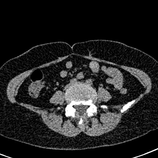 Bilateral staghorn calculi (Radiopaedia 59475-66842 Axial non-contrast 47).jpg