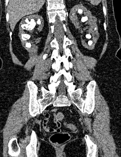 Bilateral staghorn calculi (Radiopaedia 59475-66842 Coronal non-contrast 75).jpg