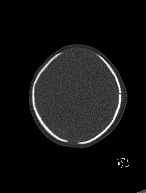 Bilateral subdural hemorrhage and parietal skull fracture (Radiopaedia 26058-26192 Axial bone window 18).png