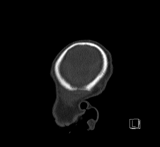 Bilateral subdural hemorrhage and parietal skull fracture (Radiopaedia 26058-26192 Sagittal bone window 5).png