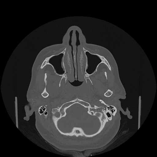 File:Bisphosphonate-related osteonecrosis of the jaw (Radiopaedia 71324-81642 Axial bone window 135).jpg