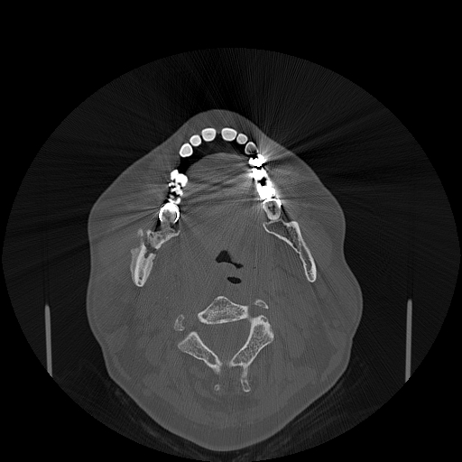 File:Bisphosphonate-related osteonecrosis of the jaw (Radiopaedia 71324-81642 Axial bone window 77).jpg