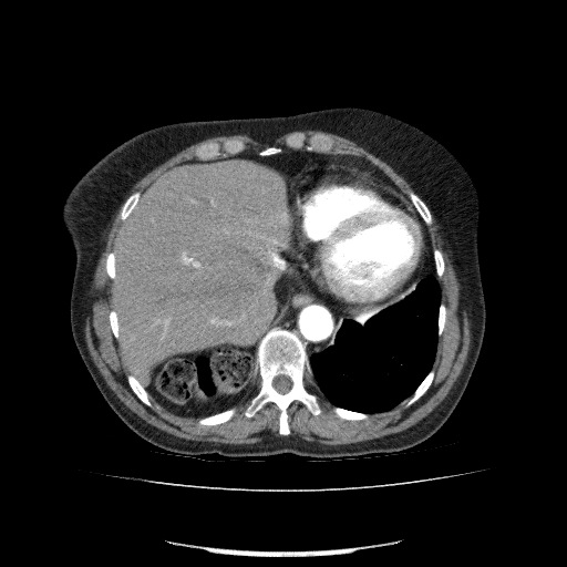 File:Bladder tumor detected on trauma CT (Radiopaedia 51809-57609 A 73).jpg