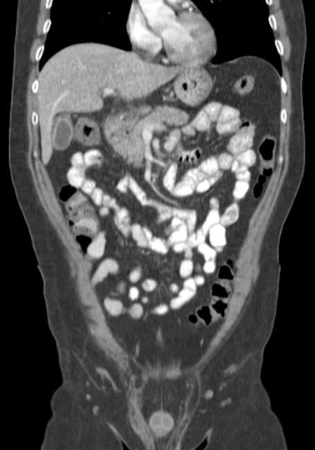 Bleeding duodenal ulcer and adenomyomatosis of gallbladder (Radiopaedia 61834-69861 B 56).jpg