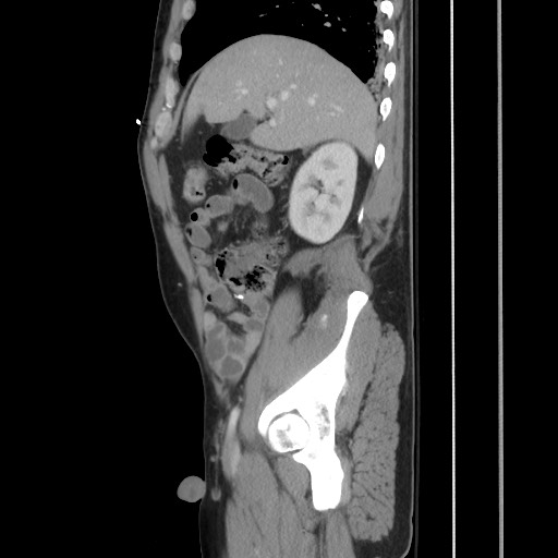 File:Blunt abdominal trauma with solid organ and musculoskelatal injury with active extravasation (Radiopaedia 68364-77895 C 48).jpg