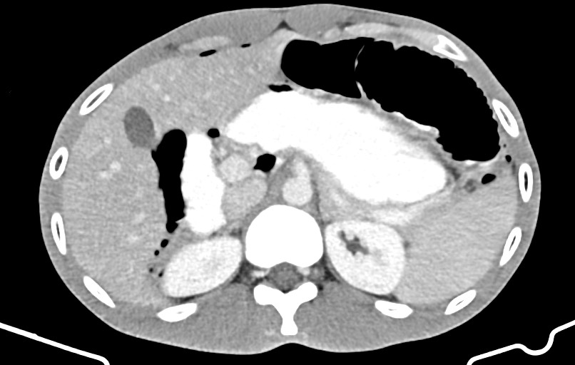 Blunt injury to the small bowel (Radiopaedia 74953-85987 A 35).jpg