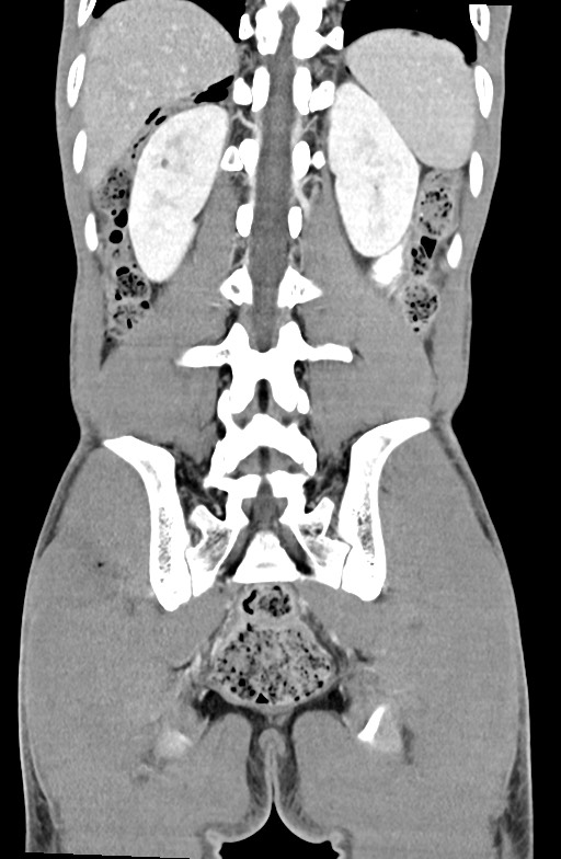 Blunt injury to the small bowel (Radiopaedia 74953-85987 B 74).jpg