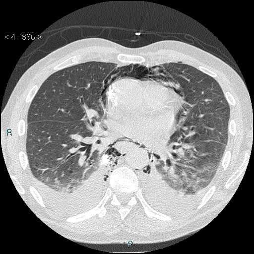 Boerhaave syndrome (Radiopaedia 27683-27897 lung window 47).jpg