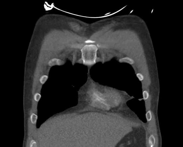 File:Boerhaave syndrome (Radiopaedia 39382-41660 C 18).png