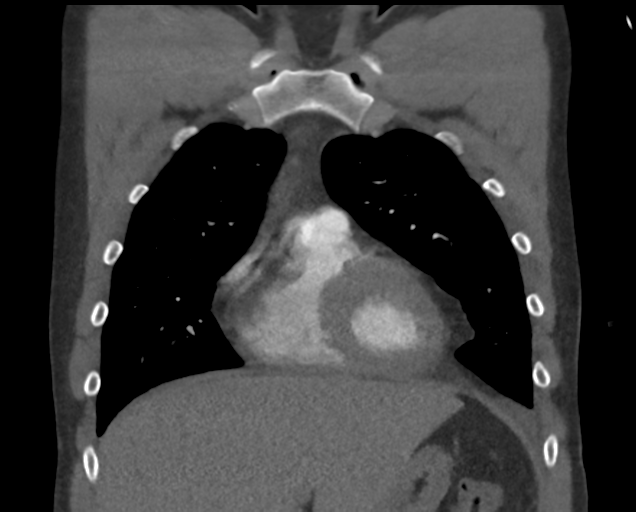 File:Boerhaave syndrome (Radiopaedia 39382-41660 C 27).png