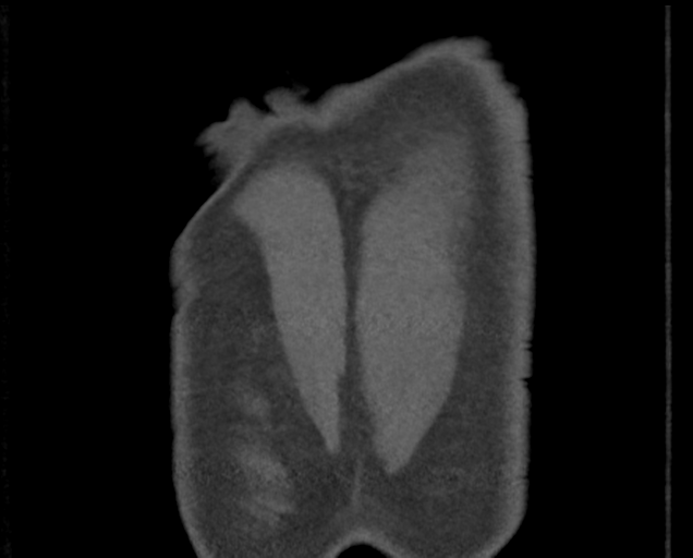 Boerhaave syndrome (Radiopaedia 39382-41660 C 90).png