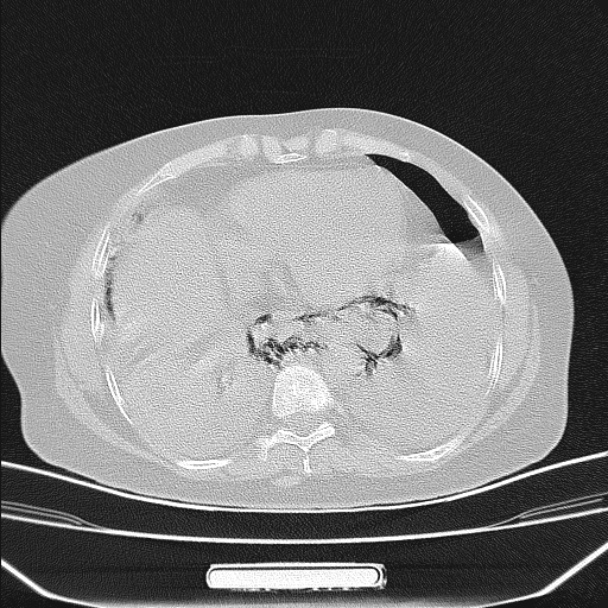 Boerhaave syndrome (Radiopaedia 45644-49799 Axial lung window 83).jpg
