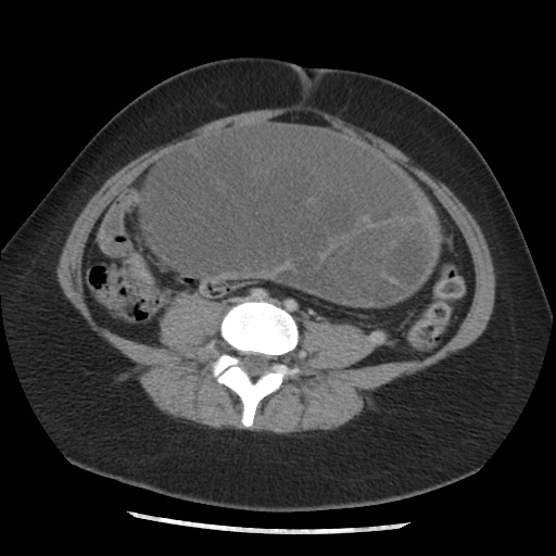 File:Borderline mucinous tumor (ovary) (Radiopaedia 78228-90808 A 102).jpg
