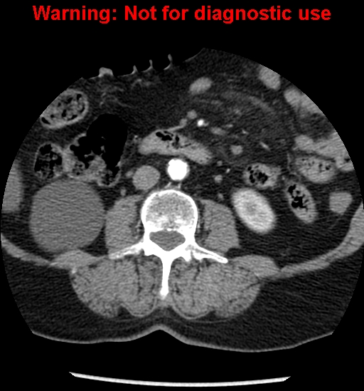 File:Bosniak renal cyst - type II (Radiopaedia 23404-23468 B 29).jpg