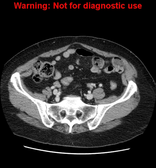 File:Bosniak renal cyst - type II (Radiopaedia 23404-23468 D 53).jpg