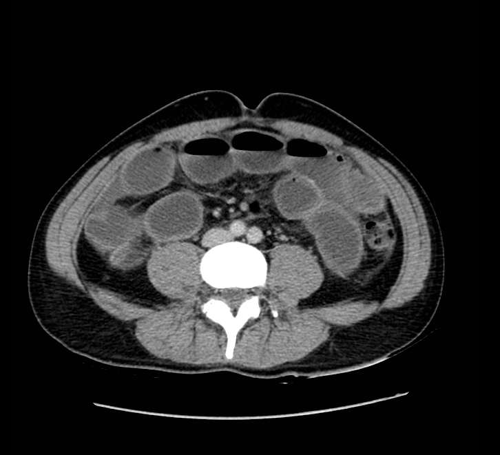 Bowel obstruction from colon carcinoma (Radiopaedia 22995-23028 A 52).jpg