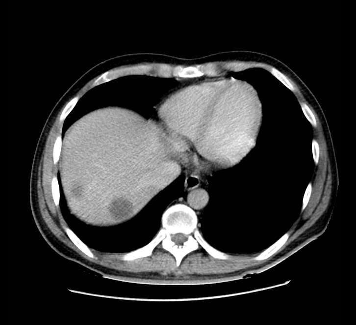 Bowel obstruction from colon carcinoma (Radiopaedia 22995-23028 A 8).jpg