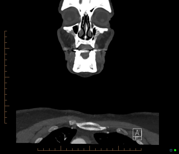 Brachiocephalic trunk stenosis (Radiopaedia 87242-103519 B 6).jpg