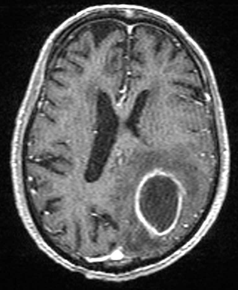 Brain abscess with dual rim sign (Radiopaedia 87566-103938 Axial T1 C+ 104).jpg