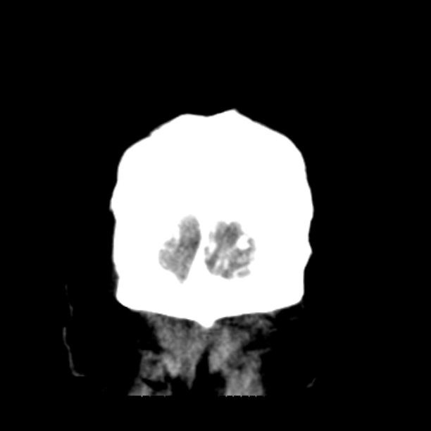 Brain cortical laminar necrosis (Radiopaedia 25822-25971 C 53).jpg