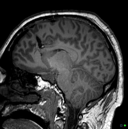 Brain death on MRI and CT angiography (Radiopaedia 42560-45689 Sagittal T1 34).jpg