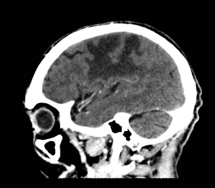 Brain metastases from lung cancer (Radiopaedia 27849-28092 Sagittal C+ delayed 16).jpg