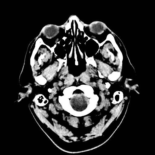 File:Brain metastases from lung cancer (Radiopaedia 83839-99027 Axial non-contrast 1).jpg