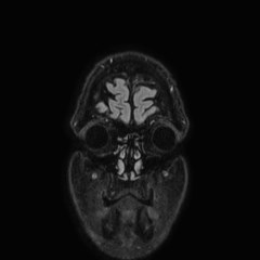 Brain metastases from lung cancer (Radiopaedia 83839-99028 Coronal FLAIR 2).jpg