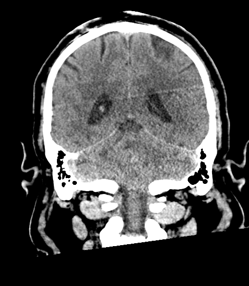 Brainstem hemorrhage (Radiopaedia 81294-94976 Coronal non-contrast 46).jpg