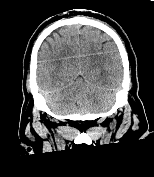Brainstem hemorrhage (Radiopaedia 81294-94976 Coronal non-contrast 53).jpg