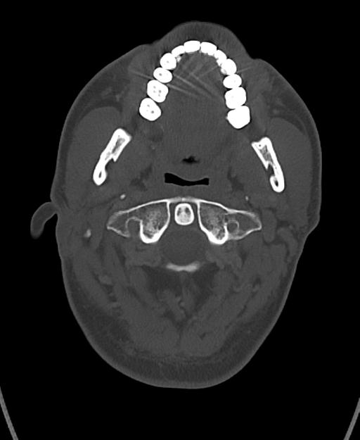 Branchial cleft cyst (Radiopaedia 31167-31875 Axial bone window 19).jpg