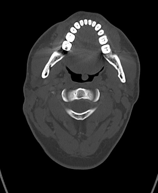 Branchial cleft cyst (Radiopaedia 31167-31875 Axial bone window 22).jpg