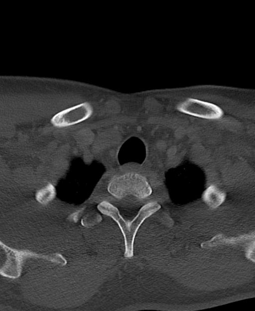 Branchial cleft cyst (Radiopaedia 31167-31875 Axial bone window 69).jpg