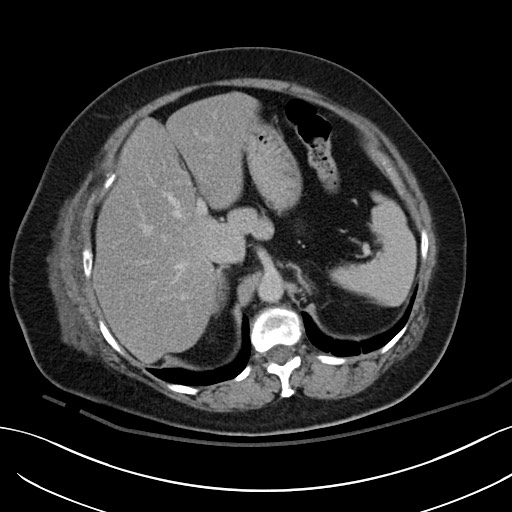 Breast carcinoma with pathological hip fracture (Radiopaedia 60314-67974 B 16).jpg